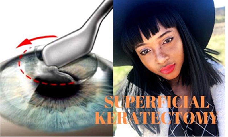 corneal scraping healing process
